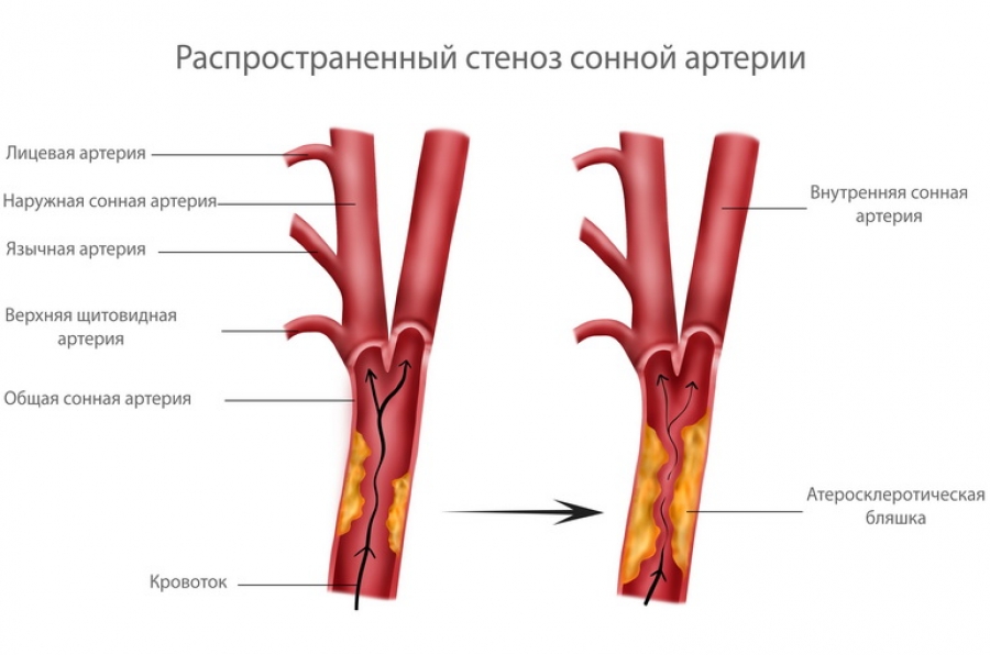 атеросклероз сонных артерий