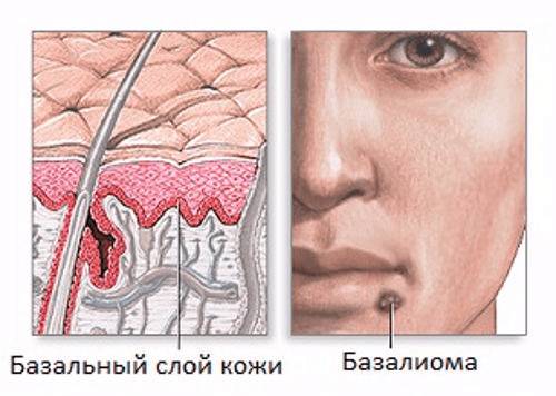 базалиома кожи лица