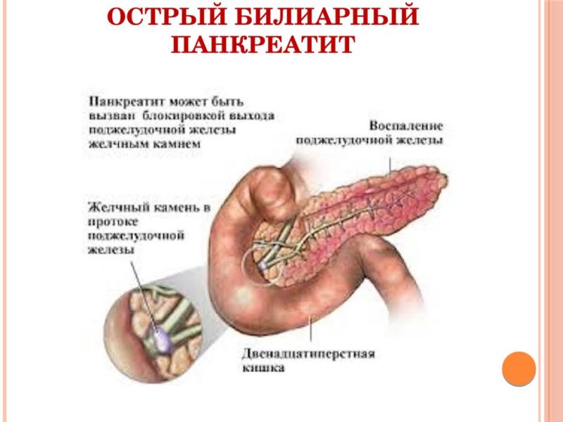 Что такое билиарнозависимый панкреатит: виды и лечение