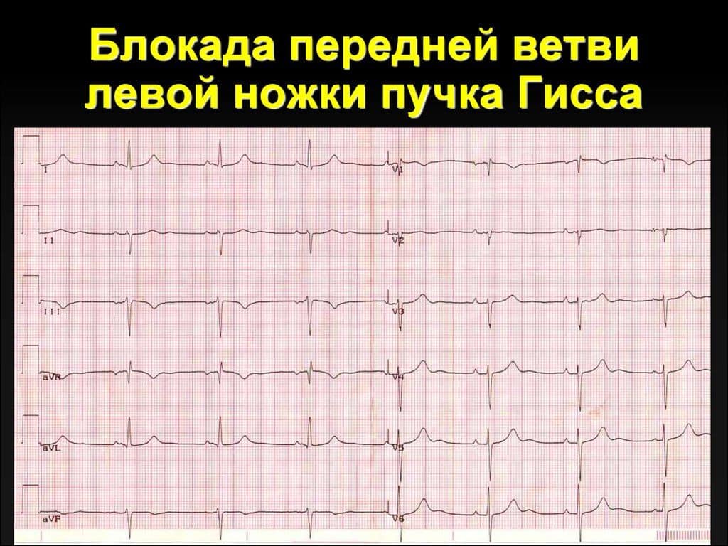 Блокада передней ветви левой ножки