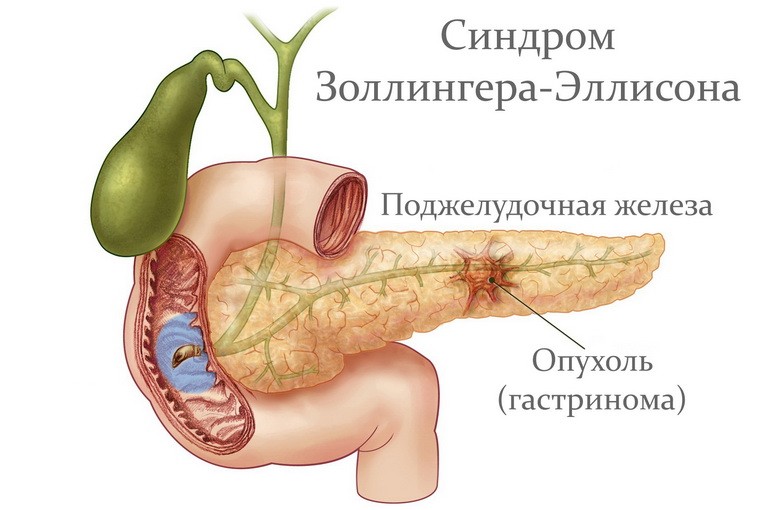 Болезнь Золлингера — Эллисона
