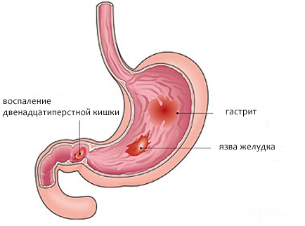 Схема расположения язвы