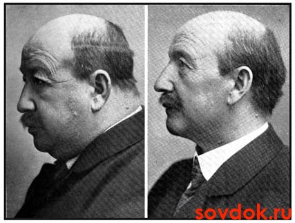 человек с гипотиреозом и здоровый