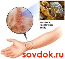чесотка