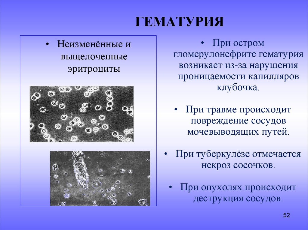 Причины гематурии