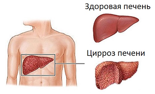 Цирроз