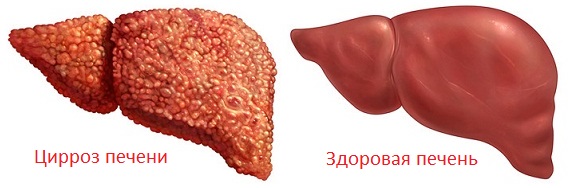 Цирроз печени