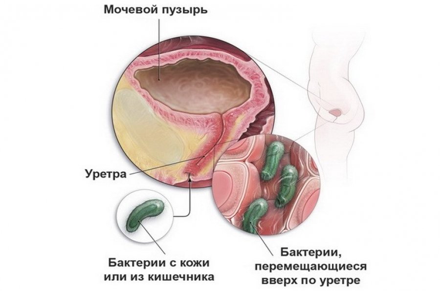 Схема восходящего пути инфицирования