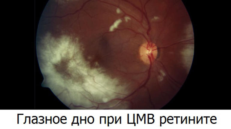 Цитомегаловирусный ретинит