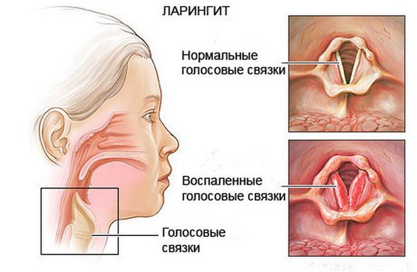 Как выглядит ларингит