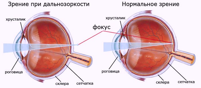 Дальнозоркость (схема)