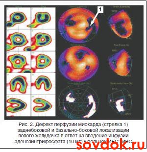 дефект перфузии миокарда