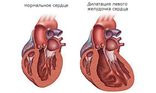 Дилатация – аномальное расширение сердечных камер