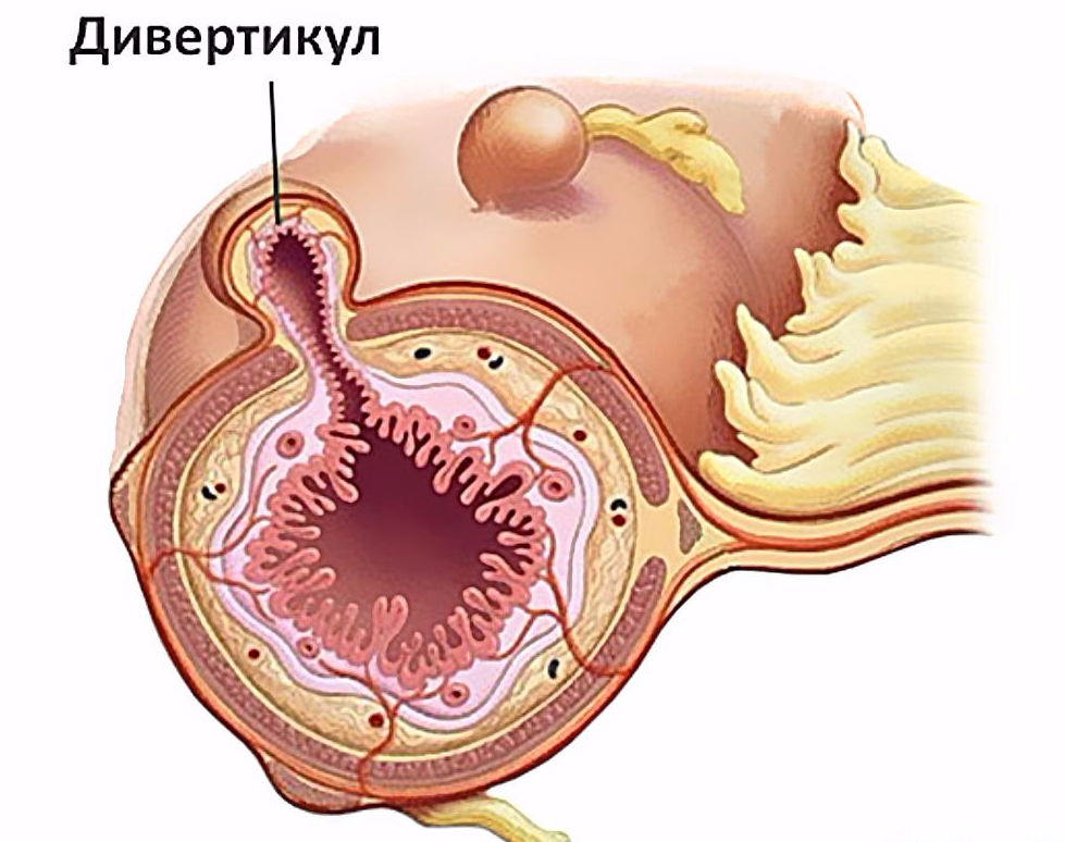 дивертикул меккеля