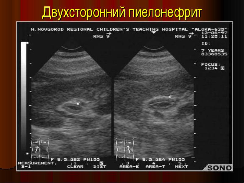 Двухсторонний пиелонефрит