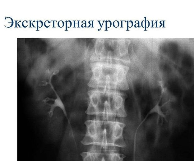 Урограмма почек при хроническом пиелонефрите