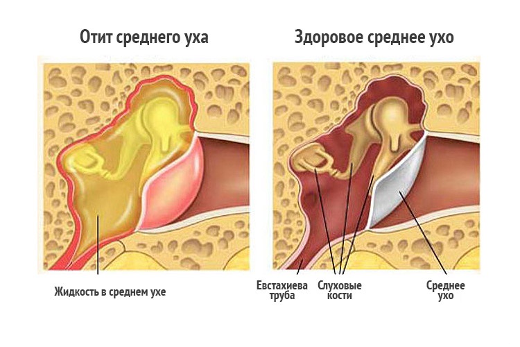 Экссудативный отит
