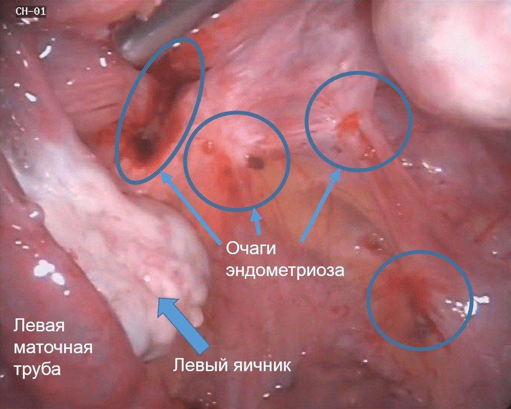 Эндометриоз матки
