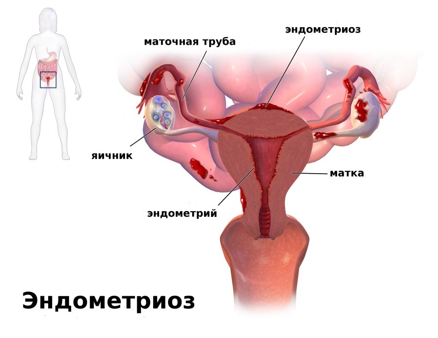 Эндометриоз