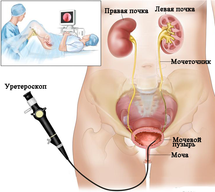 Эндоскопическое удаление камней