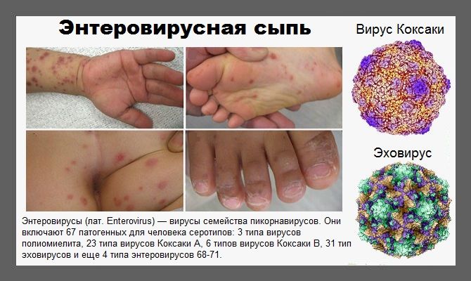 Энтеровирусная инфекция