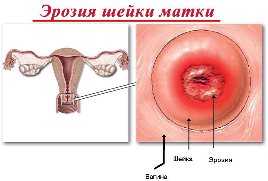эрозия шейки матки