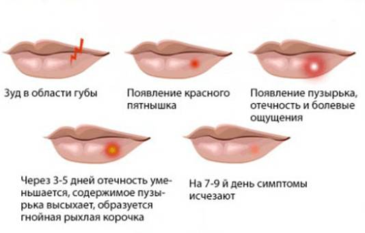 Этапы эволюции пузырьковой сыпи при герпесе
