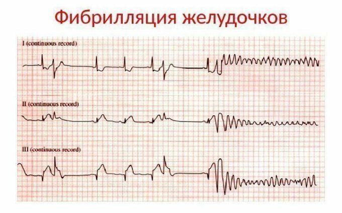 Фибрилляция желудочков