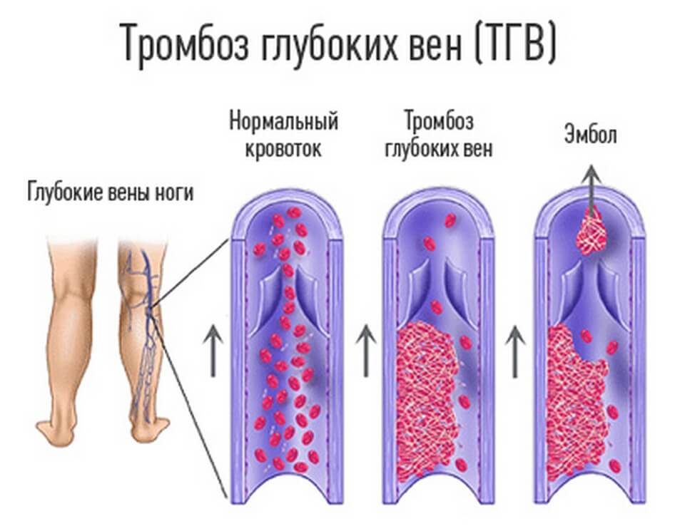Причины ПТФС