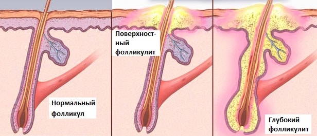 Фолликулит