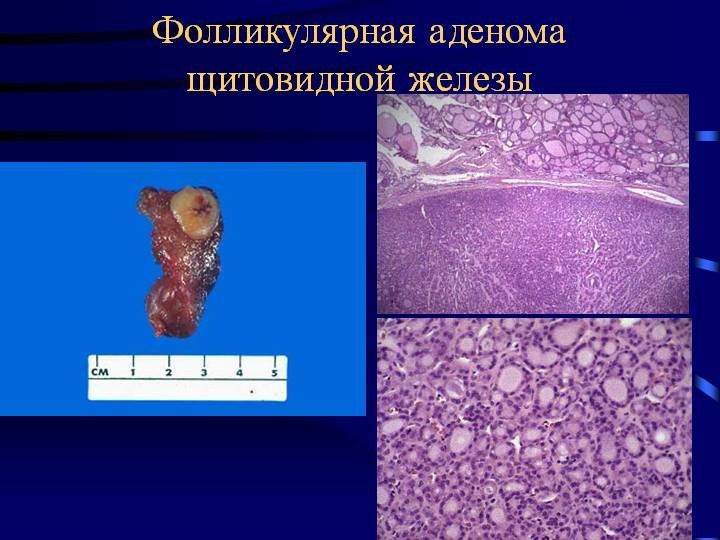 Фолликулярная аденома