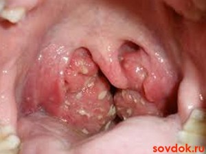 фолликулярный тонзиллит