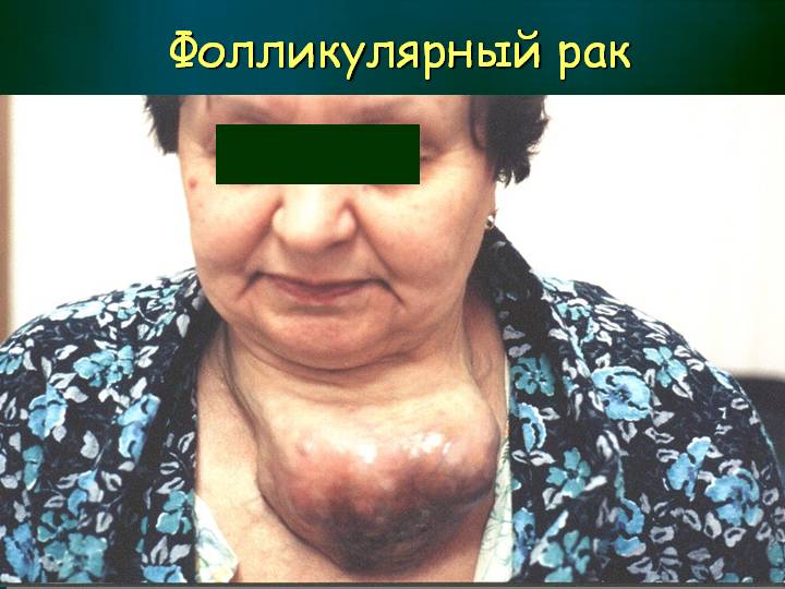 Фолликулярный рак