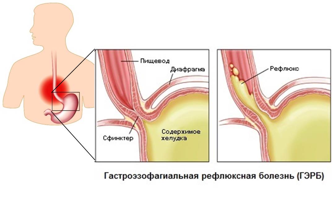 Гастроэзофагеальный рефлюкс (схема)