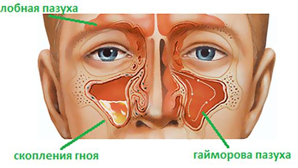 Гайморит