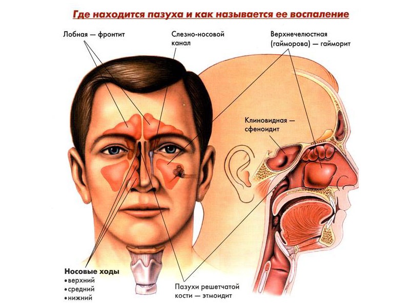 Гайморит