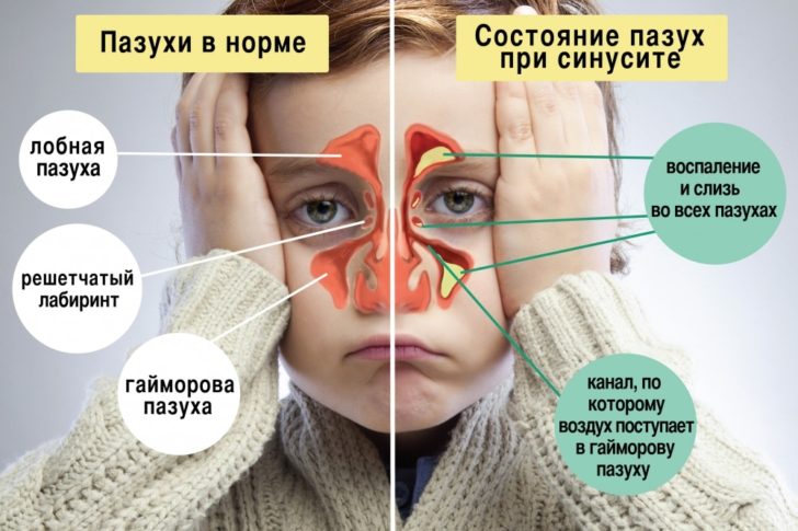 Схема состояния придаточных пазух в норме и во время синусита