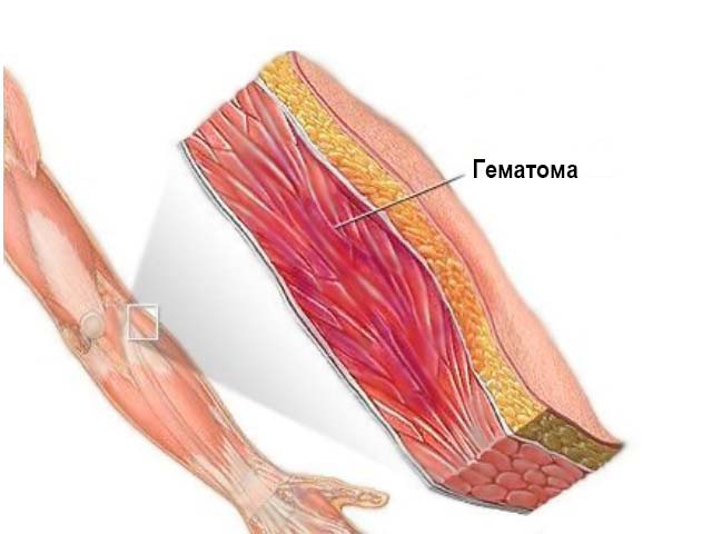 Гематома предплечья (схема)