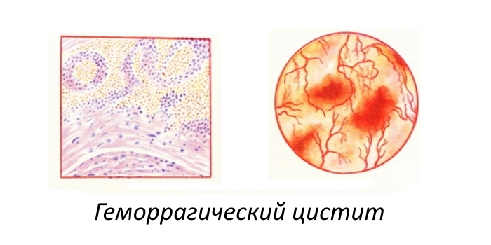 Геморрагический цистит