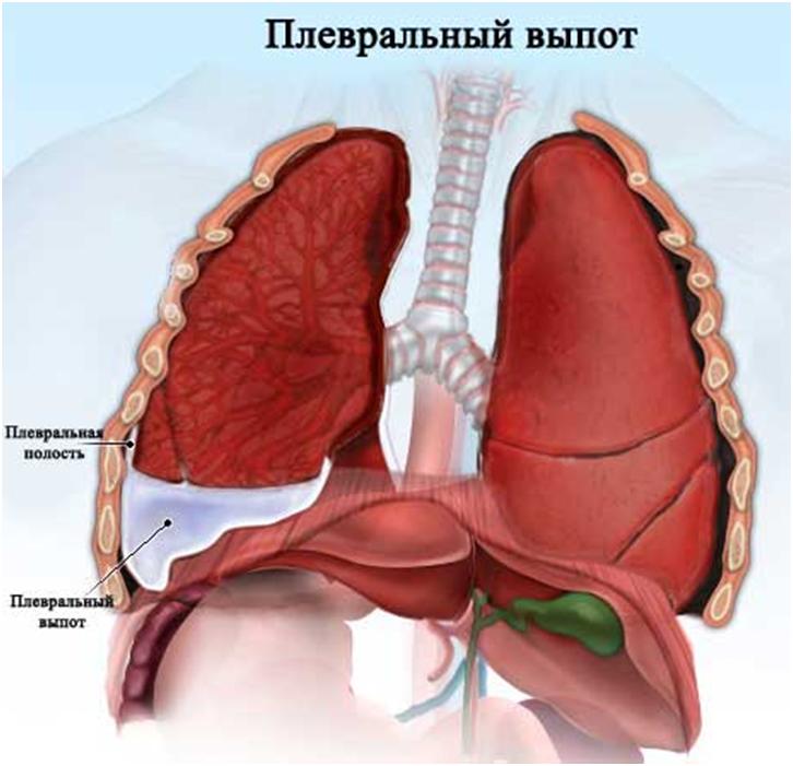 Жидкость в легких