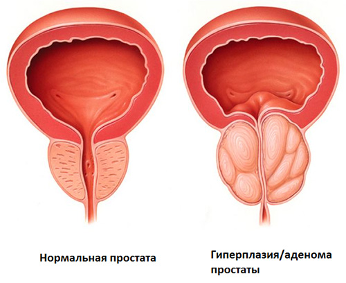 Гиперплазия предстательной железы