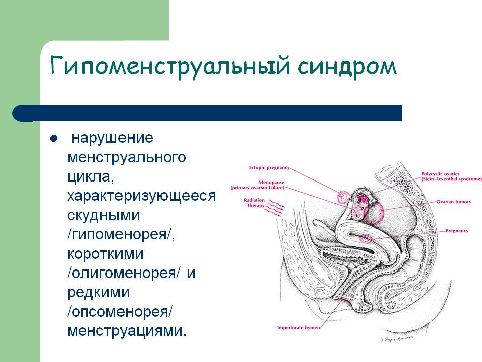 Гипоменструальный синдром