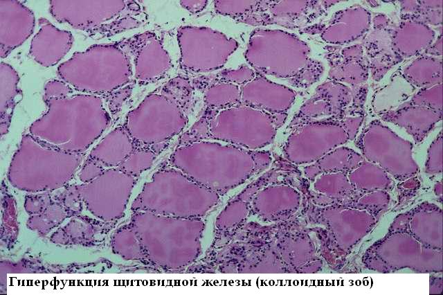 Микрофотография: клетки щитовидной железы при коллоидном зобе