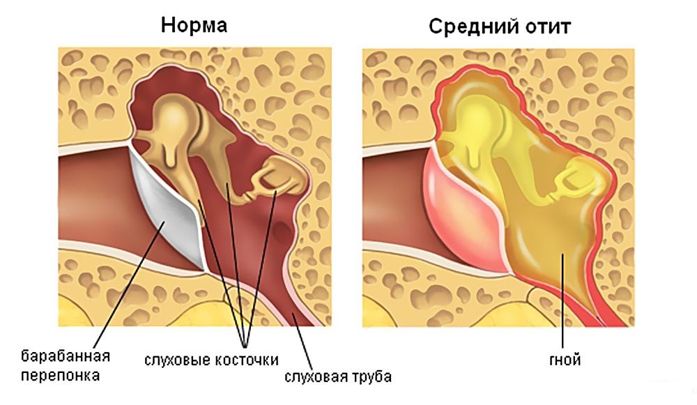 Гнойный отит