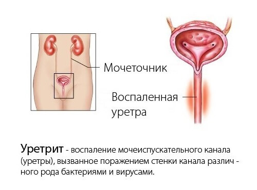 Гонорейный уретрит (схема)