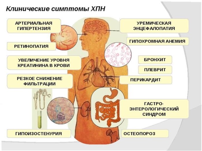 Хроническая почечная недостаточность (схема)