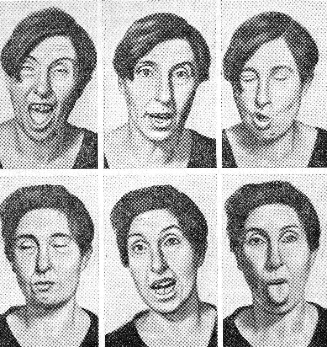 Гримасы при хорее