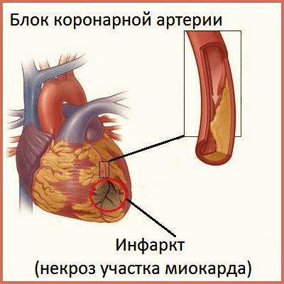 Инфаркт миокарда