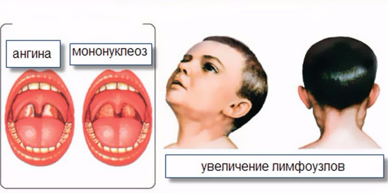 Инфекционный мононуклеоз и ангина