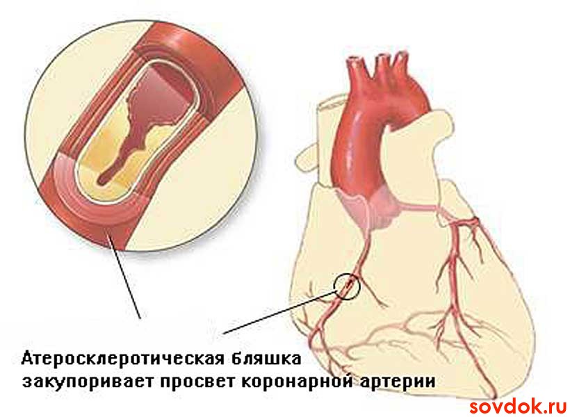 ишемическая болезнь сердца